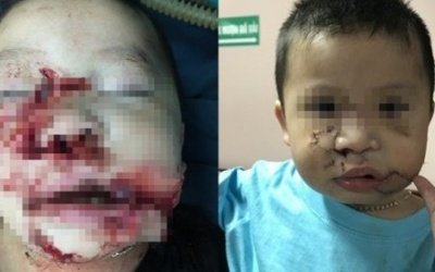 Bé trai 2 tuổi bị chó cắn nát mặt được tạo hình thành công
