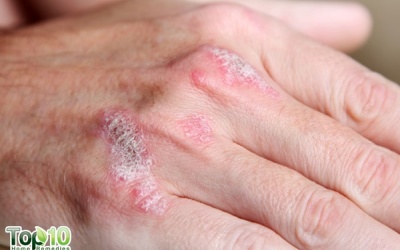 Biện pháp “chặn đứng” bệnh vẩy nến thể đảo ngược