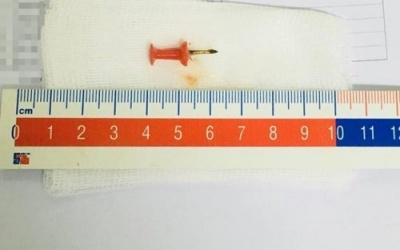 Bé gái 12 tuổi suýt mất mạng vì nuốt phải ghim sắt