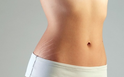 Những điều cần biết về rạn da