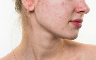 10 cách điều trị mụn nội tiết tốt nhất hệ mặt trời