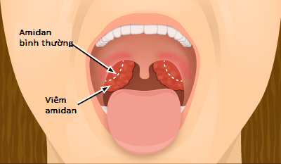 Trẻ bị viêm amidan: Điều trị và phòng ngừa cách nào hiệu quả?