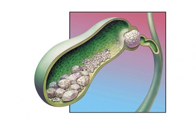 6 dấu hiệu cảnh báo các vấn đề túi mật nghiêm trọng ở phụ nữ