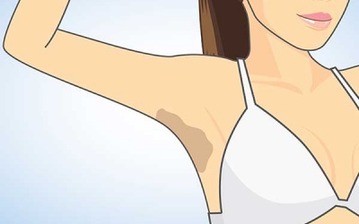 Da dưới cánh tay bị thâm: Có cách nào làm sáng da?