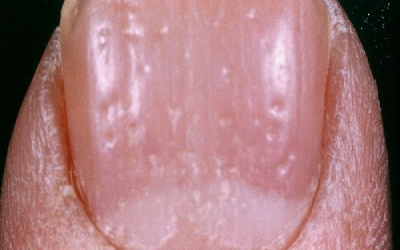 Móng tay có những vết lõm là dấu hiệu của bệnh gì?