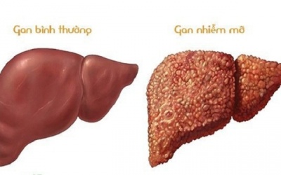 Gan nhiễm mỡ có chữa khỏi được không?