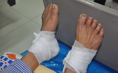 Cảnh báo: Bỏng chân do đắp hỗn hợp lá ngải cứu trị đái tháo đường