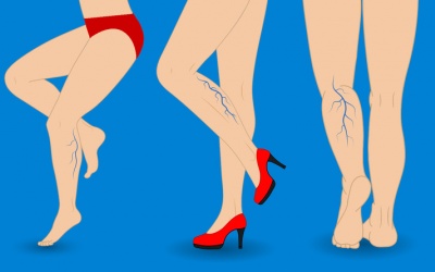 8 cách tự nhiên giúp cải thiện suy giãn tĩnh mạch