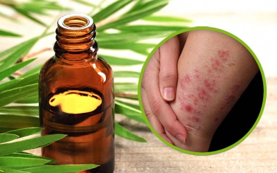 Điều trị chàm bằng tinh dầu tràm trà như thế nào?