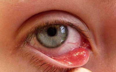 4 bệnh về mắt thường gặp trong mùa Hè