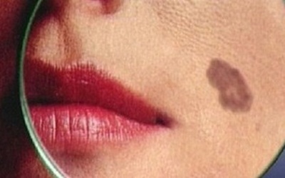 Những cách ngăn ngừa ung thư da hiệu quả