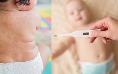 Sốt phát ban và sởi ở trẻ em khác nhau thế nào? 