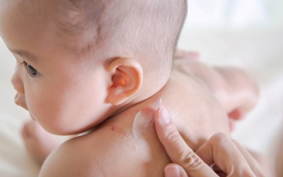 Nổi mụn nước trên đầu có nên bôi Subạc?
