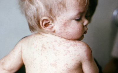 Triệu chứng bệnh sởi ở trẻ: Đừng nhầm với cảm lạnh hay sốt phát ban!