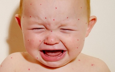 Những biến chứng nguy hiểm của bệnh sởi ở trẻ em