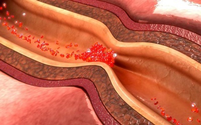 Phòng ngừa bệnh tim mạch vành dễ hơn nếu biết được điều này