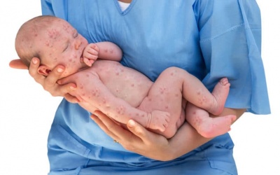 Trẻ bị sởi cần kiêng gì?
