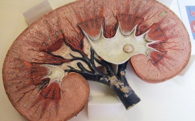 6 lời khuyên giúp bạn loại bỏ sỏi thận một cách tự nhiên