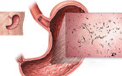 Biến chứng nguy hiểm của viêm dạ dày ruột do vi khuẩn 