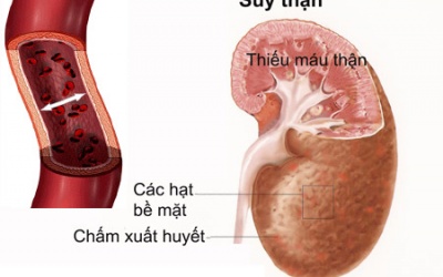Bệnh đái tháo đường gây biến chứng suy thận điều trị ra sao?