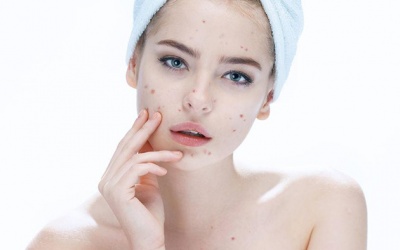 4 tình trạng da thường bị hiểu nhầm là mụn trứng cá