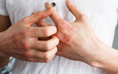 7 cách đơn giản giúp phòng ngừa eczema
