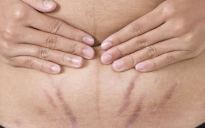 Làm sao để xóa mờ vết rạn da?