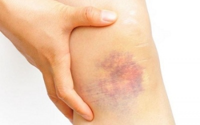 Da dễ bị bầm tím là bị bệnh gì?