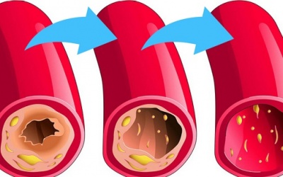 5 thực phẩm giúp làm sạch động mạch, ngăn ngừa đột quỵ, đau tim