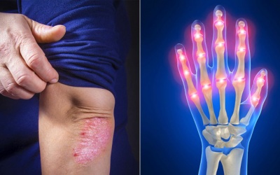 Có thể bị viêm khớp vẩy nến và viêm khớp dạng thấp cùng lúc hay không?