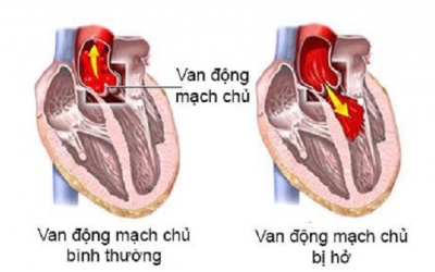 Hở van động mạch chủ 2/4 có nguy hiểm không?