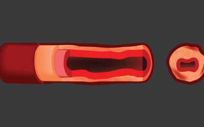 Các loại viêm mạch thường gặp