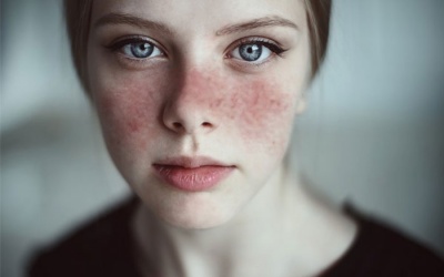 Lợi khuẩn có thể cải thiện triệu chứng của bệnh tự miễn?