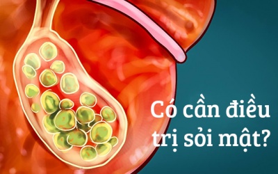 Bị sỏi mật nhưng chưa có triệu chứng bất thường: Liệu đã cần phải điều trị?