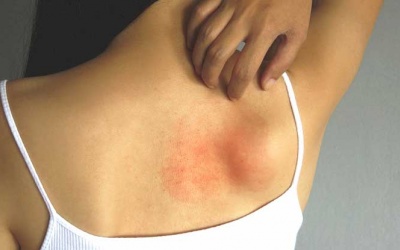 Eczema tái phát trị dứt điểm cách nào?