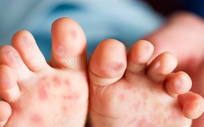 Bệnh tay chân miệng có dễ lây lan?