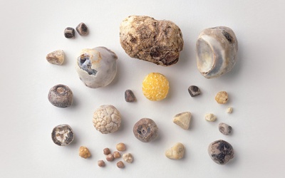 Sỏi mật khác gì sỏi thận và làm sao để điều trị sỏi mật?