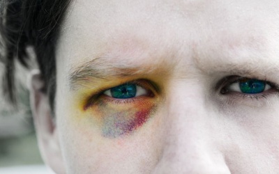 Màu sắc của vết bầm: Từ đỏ chuyển sang xanh, tím có bất thường?