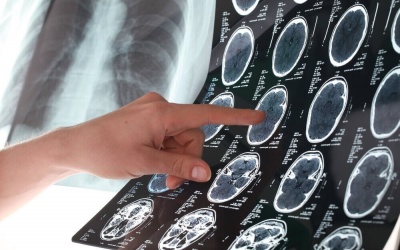 7 mẹo đơn giản giúp phòng ngừa đột quỵ