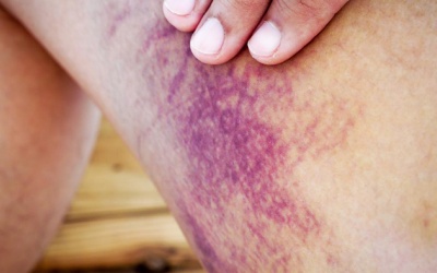 Bị bầm tím: Khi nào gây nguy hiểm?