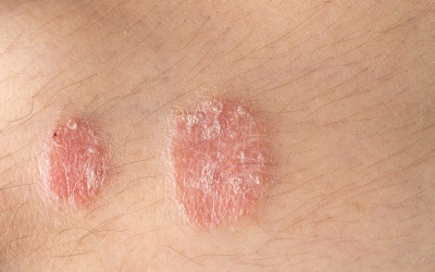 Mắc bệnh vẩy nến nên ăn gì để hạn chế bệnh bùng phát?