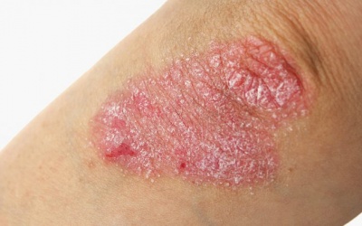 5 điều về bệnh vẩy nến bạn không nên bỏ qua!