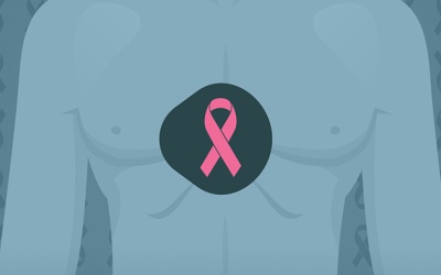 Phát hiện ung thư vú ở nam giới như thế nào?