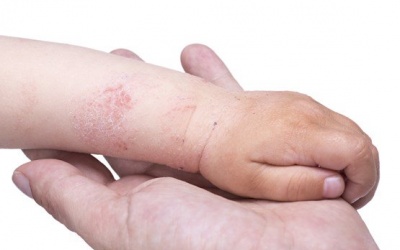 Trẻ bị bệnh eczema nặng phải làm sao?