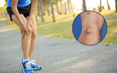 Bị u nang bao hoạt dịch kheo gối phải làm sao?