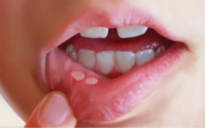 Nấm miệng có nên bôi kem thảo dược Subạc?