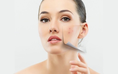 Có nên sử dụng thuốc nội tiết tố nữ điều trị mụn?