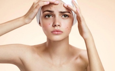 Làm thế nào để nhận biết và điều trị mụn do rối loạn nội tiết tố?