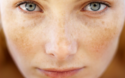 Bộ sản phẩm Babolica có cải thiện được đốm nám, da sạm không?