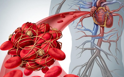 Đâu là biến chứng nguy hiểm nhất của bệnh rung nhĩ?